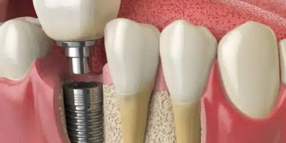 Are Dental Implants as Effective as Natural Teeth?